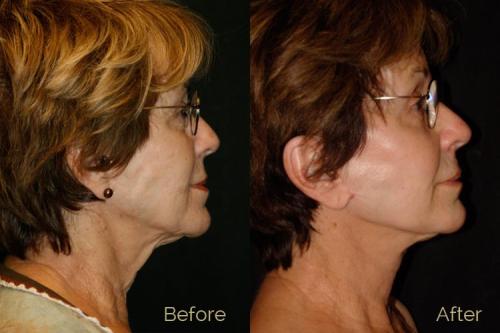 Before-and-after-pictures-of-a-woman-who-had-a-facelift