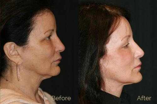 Before-and-after-side-view-pictures-of-a-woman-who-had-a-facelift