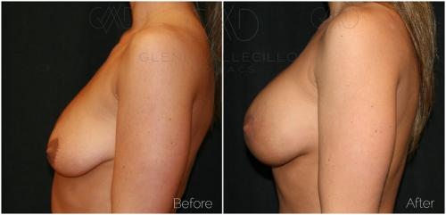 Breast-Augmentation-Mastopexy-Patient-6-1 (1)