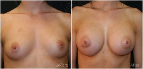 Breast-Augmentation-Patient-F (1)