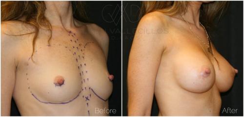 Breast-Augmentation-Patient-G1 (1)