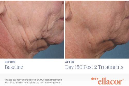 Ellacor-Before-and-After-Day-150-Post-2-Treatments
