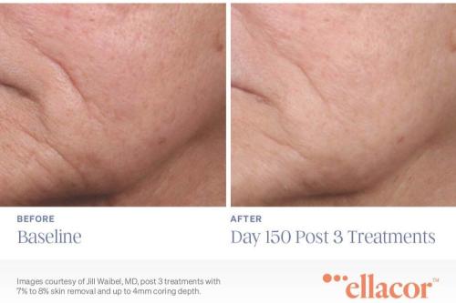 Ellacor-Before-and-After-Day-150-Post-3-Treatments