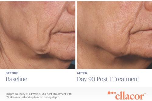 Ellacor-Before-and-After-Day-90-Post-1-Treatment