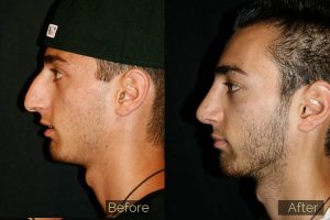 Plastic-surgery-nose-job-before-and-after-photo-1-300x200-1