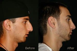 Plastic-surgery-nose-job-before-and-after-photo-2-300x200-1